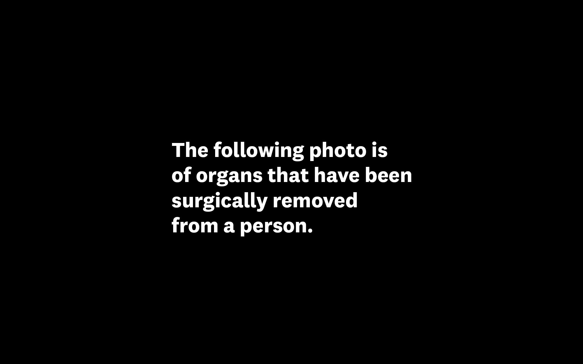 The following photo is of organs that have been surgically removed from a person.