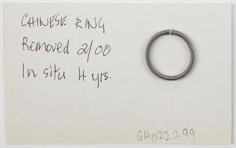 Piece of paper with the words ‘Chinese ring, removed 2/00, in situ 4 years’ and a coiled ring attached to it