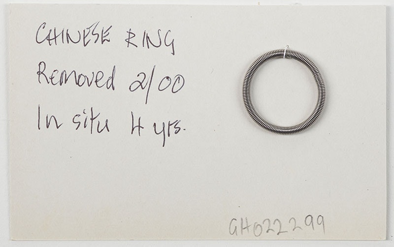Piece of paper with the words ‘Chinese ring, removed 2/00, in situ 4 years’ and a coiled ring attached to it