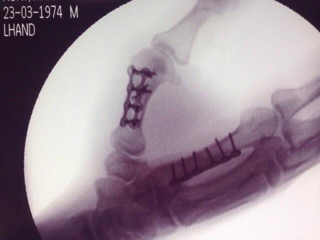 X-ray of Mark Hunt's hand. Courtesy of Mark Hunt an X-ray of a damaged hand showing wiring and bolts in two of the fingers